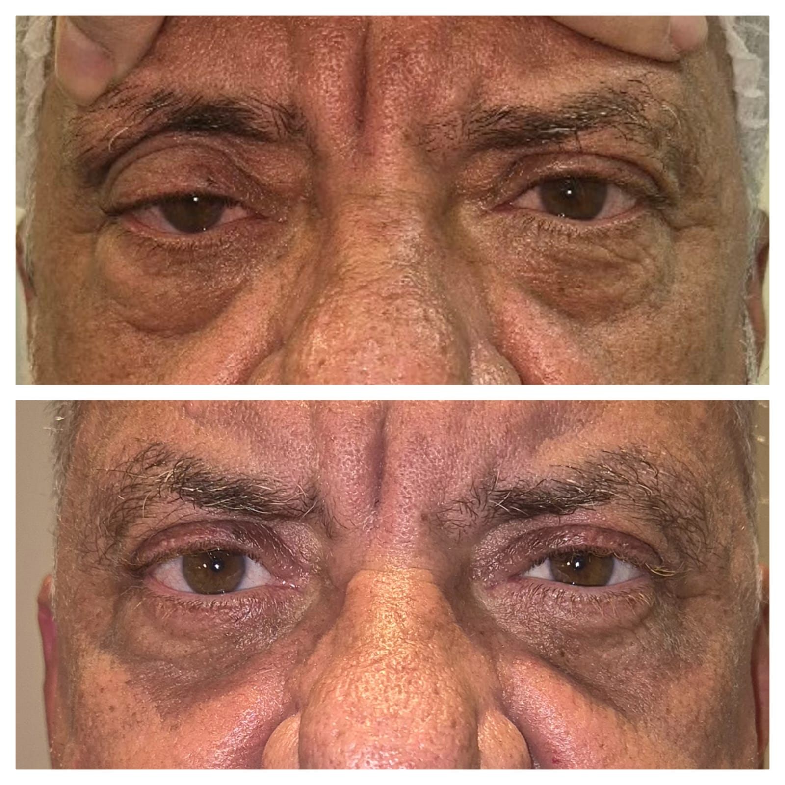 Antes e depois de blefaroplastia 13